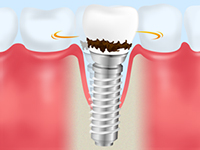 インプラント歯周炎とは(3)